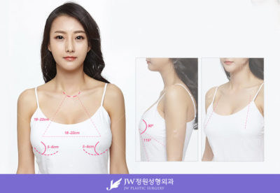 Breast Surgery in Seoul