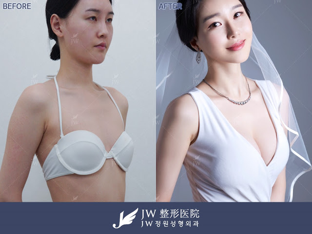 Breast Surgery in korea