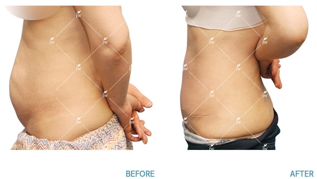 plastic surgery body contouring korea