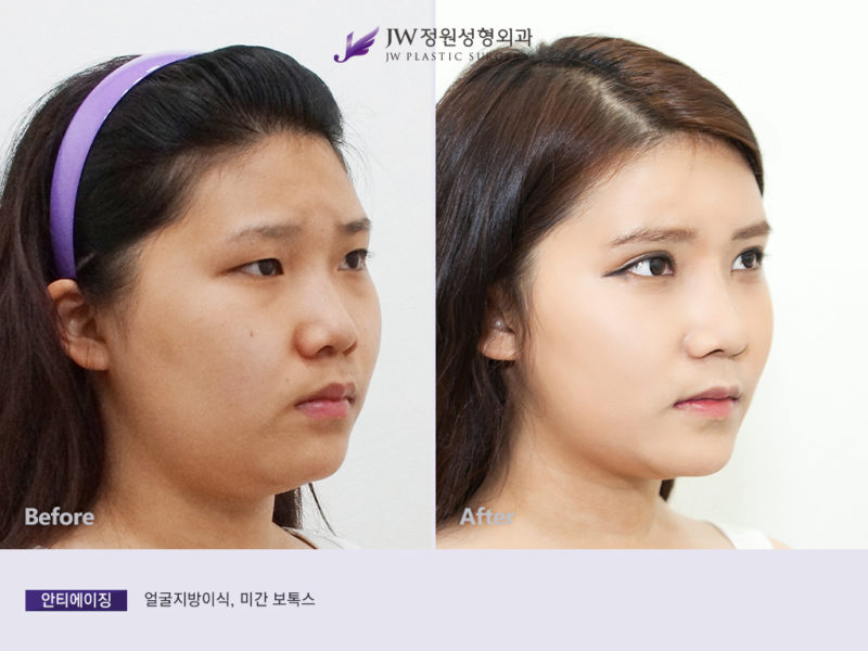 Non-surgical Facial Contouring